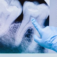 Wisdom Tooth Removal