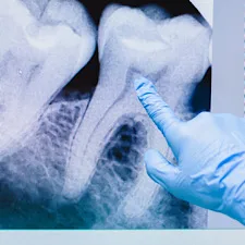 Wisdom Tooth Removal