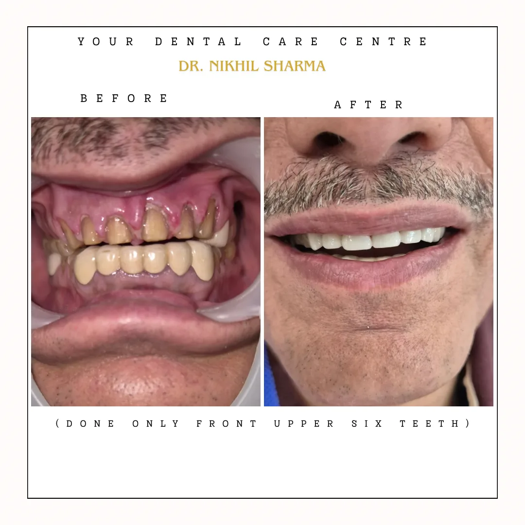 Digital Zirconia Crowns