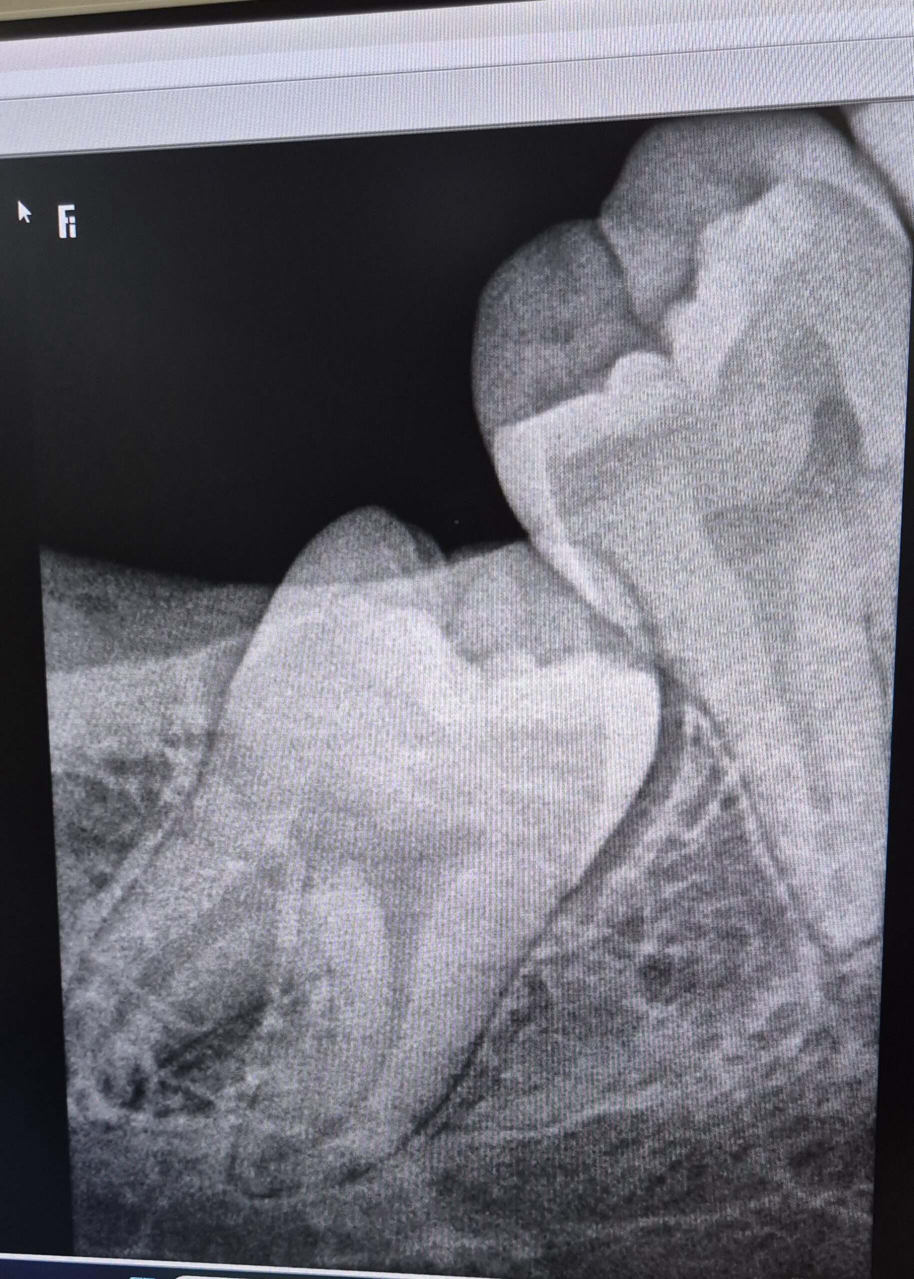Wisdom Tooth X-ray