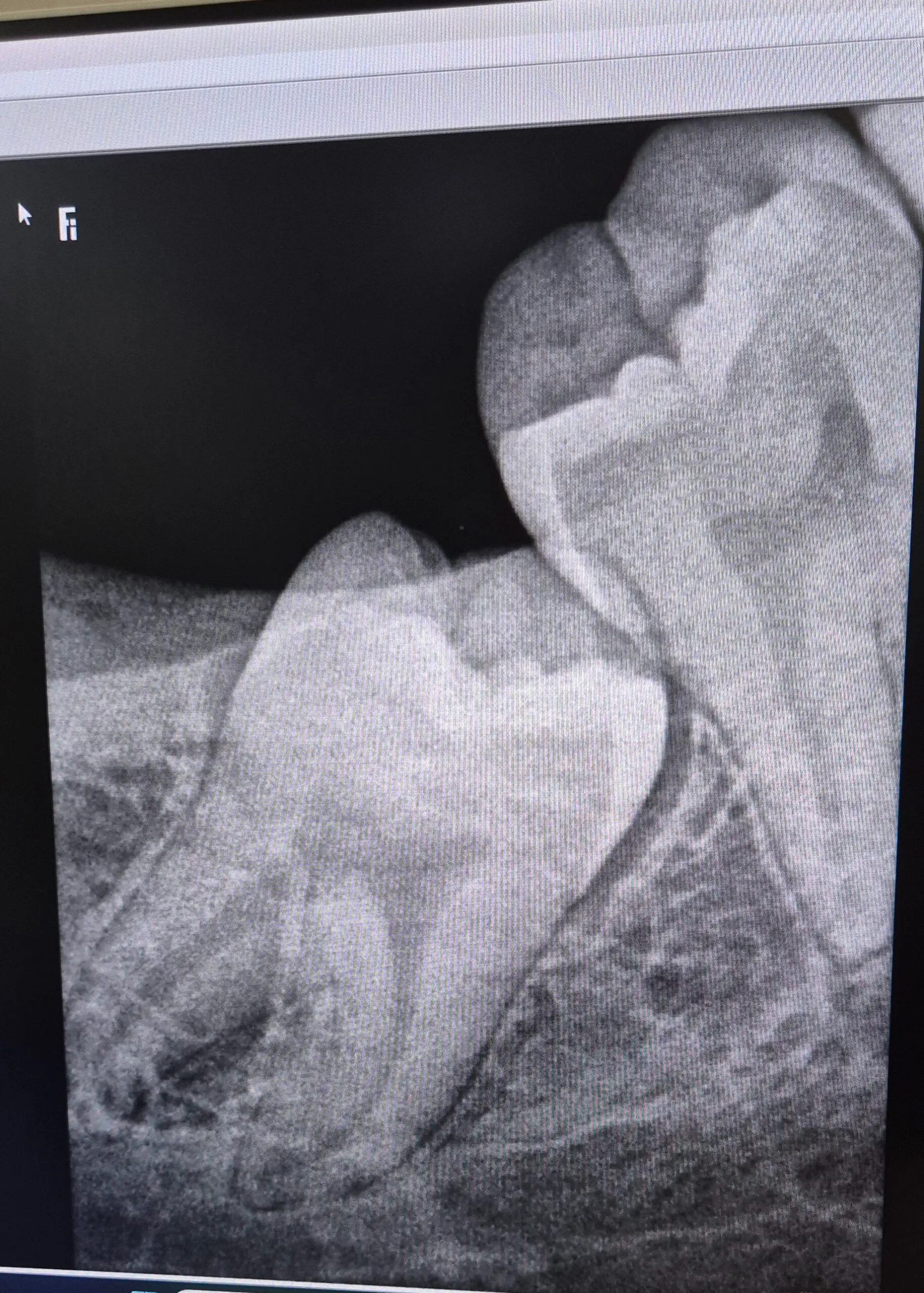 Wisdom Tooth X-ray