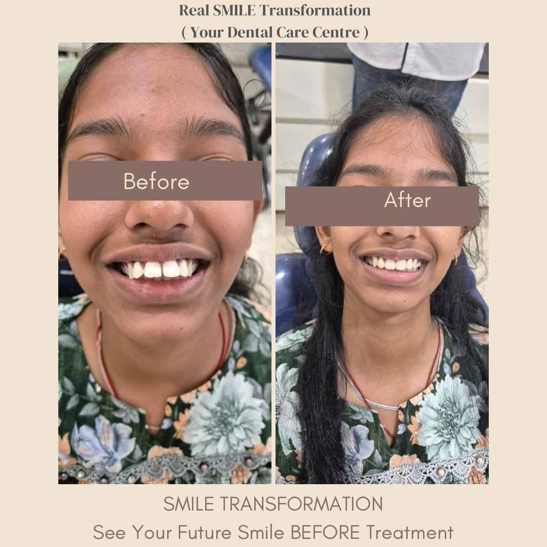 Braces Before & After