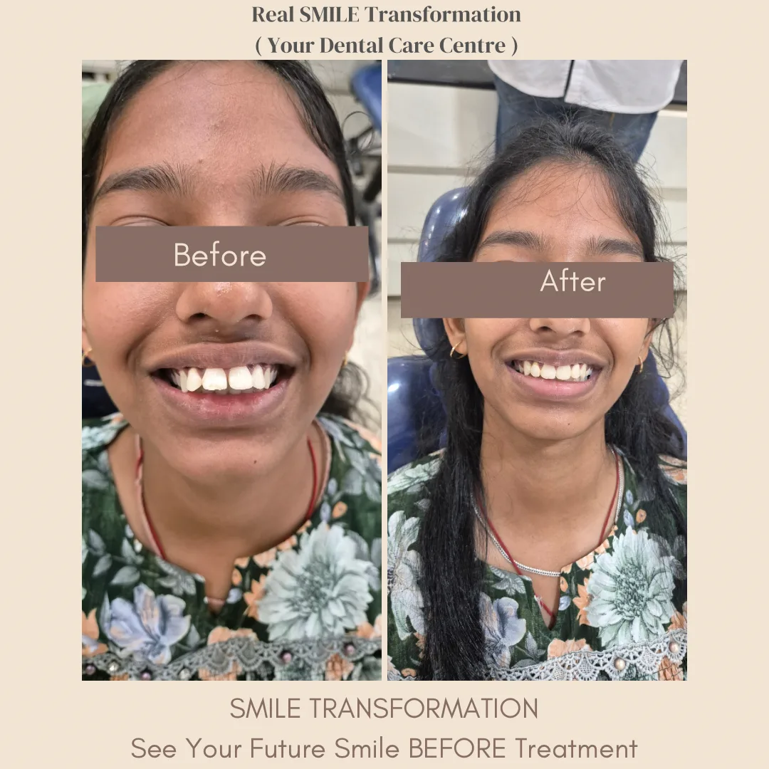 Braces Before & After