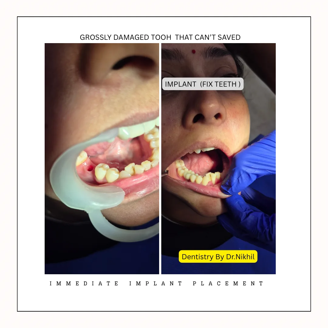 Dental Implant