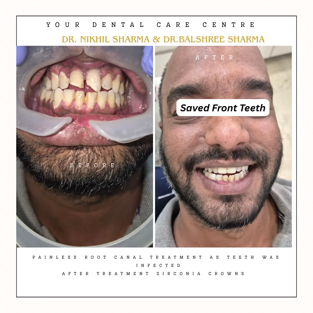 Re-RCT and Veeners