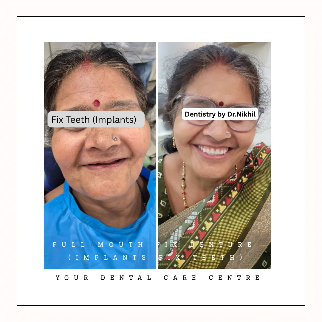 FullMouth Fix DTeeth or Fix Denture