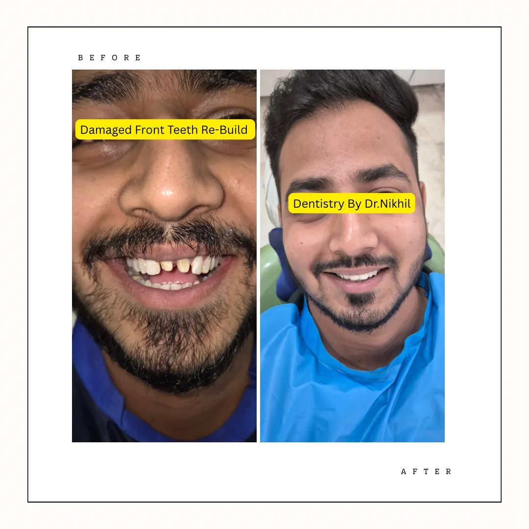 Re-Rct and tooth buildup and digital zirconia crowns