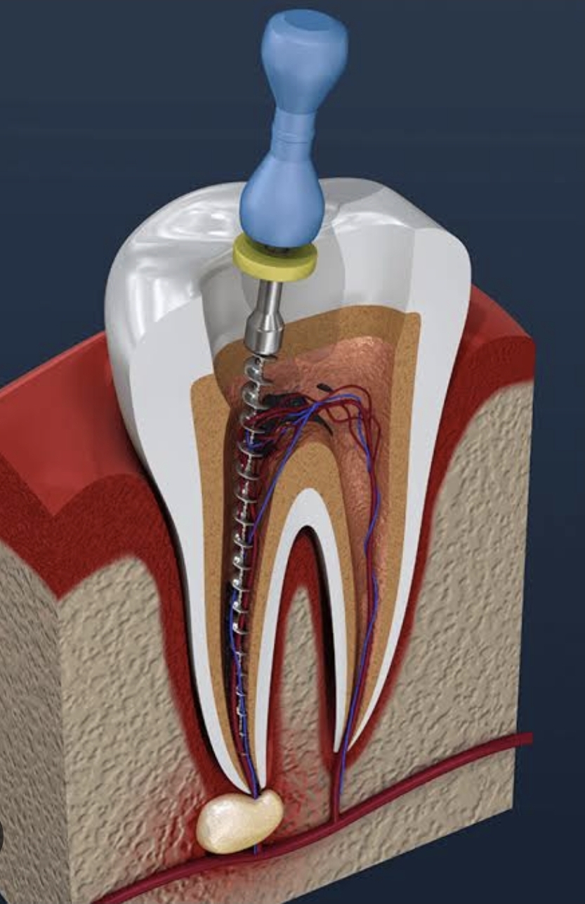 Root Canal Treatment in Kota