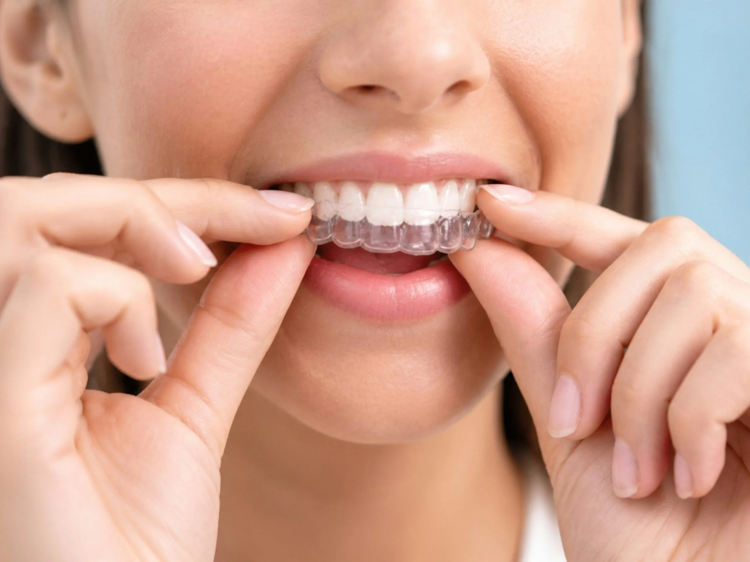 Invisible Braces / Clear Aligners