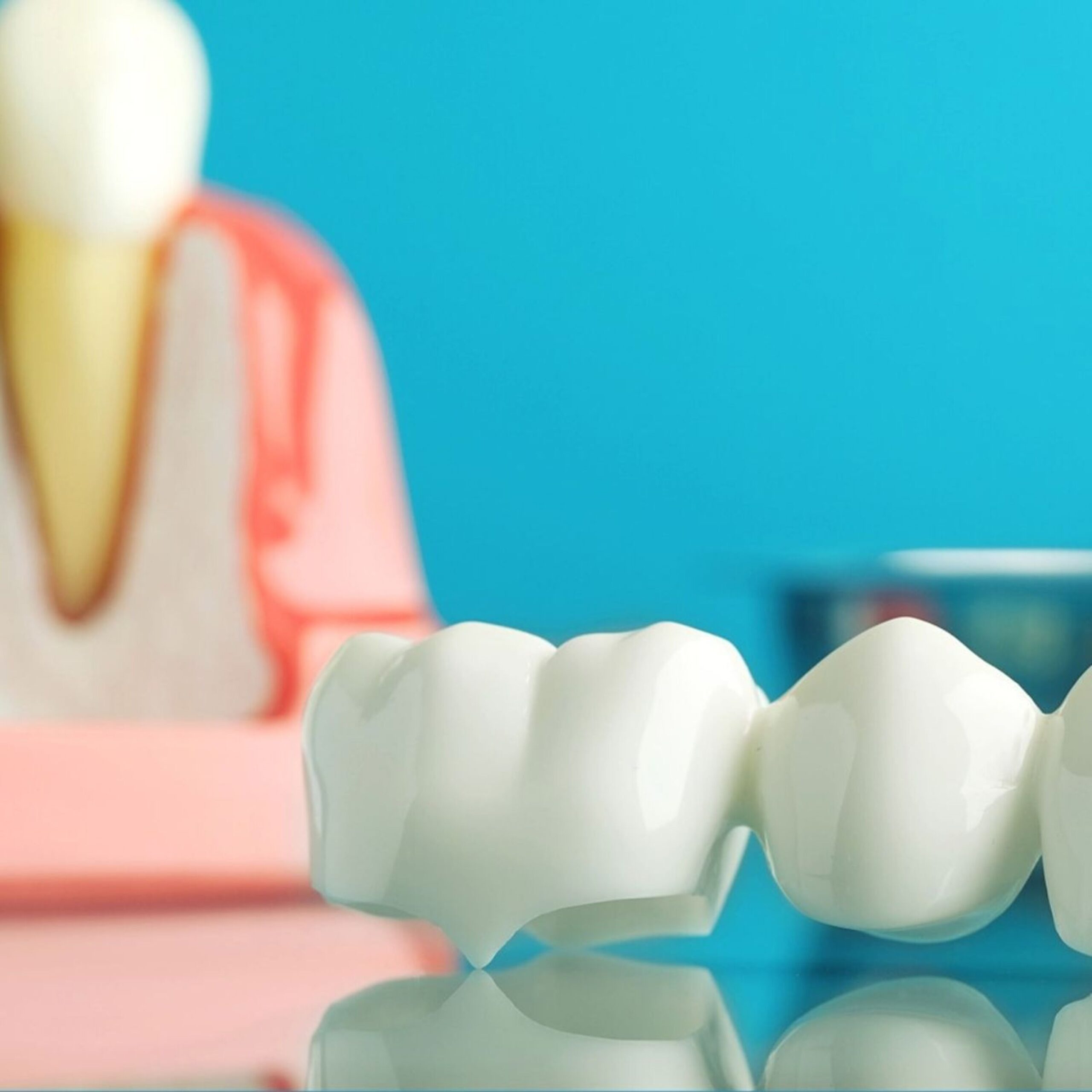 Dental Crowns & Caps