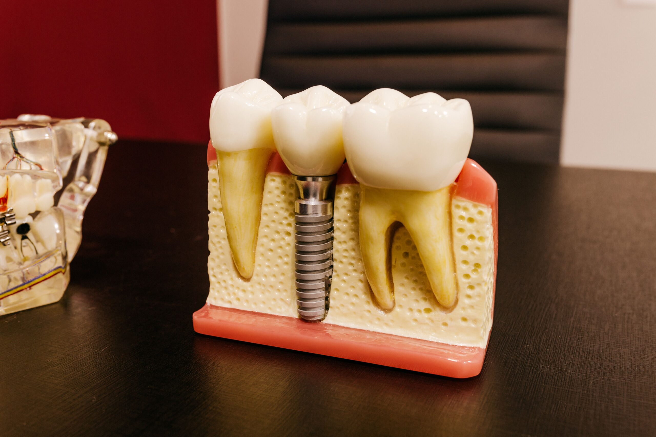 Dental Implants.