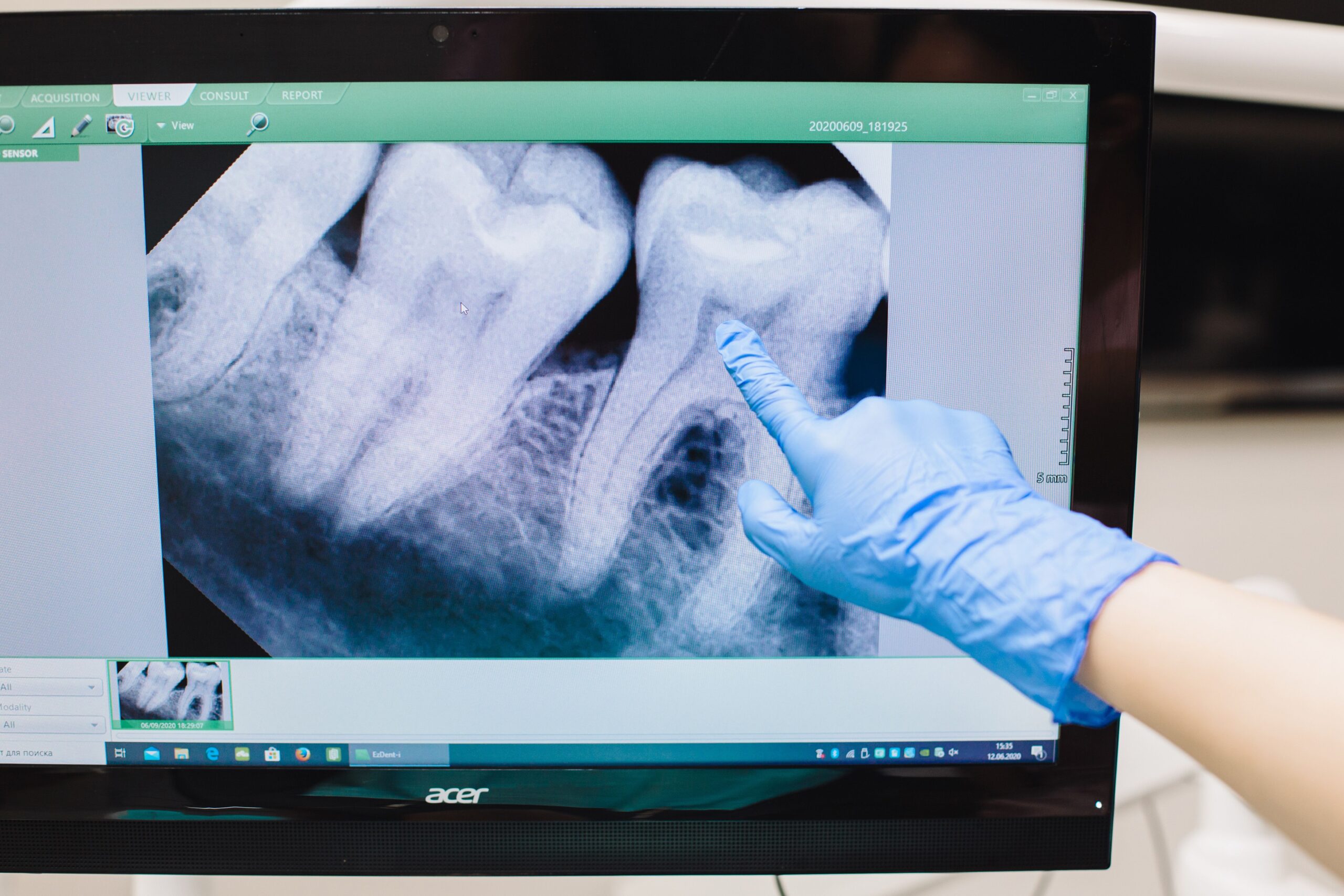 Wisdom Tooth Removal